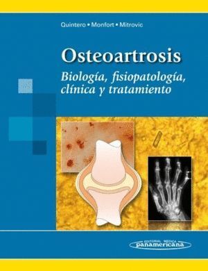 OSTEOARTROSIS